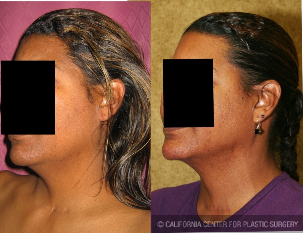 Neck & Face Liposuction Before & After Patient #6659