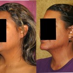 Neck & Face Liposuction Before & After Patient #6659