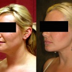 Neck & Face Liposuction Before & After Patient #6609