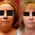 Neck & Face Liposuction Before & After Patient #6663