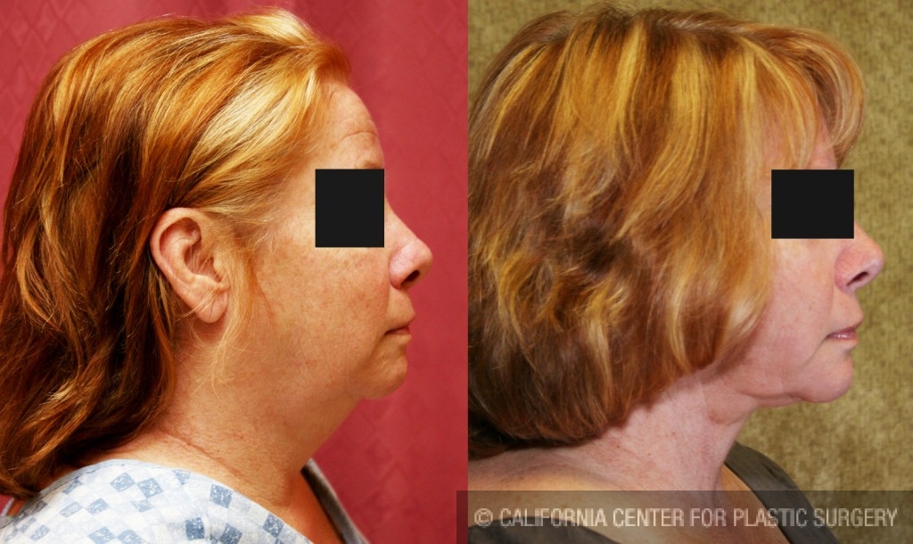 Neck & Face Liposuction Before & After Patient #6663