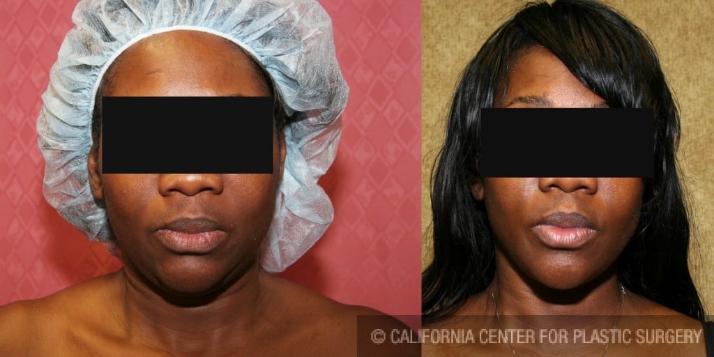 Neck & Face Liposuction Before & After Patient #6667