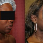 Neck & Face Liposuction Before & After Patient #6667