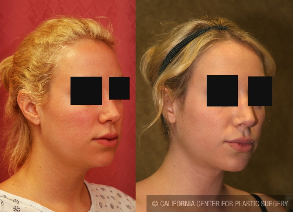 Neck & Face Liposuction Before & After Patient #6673