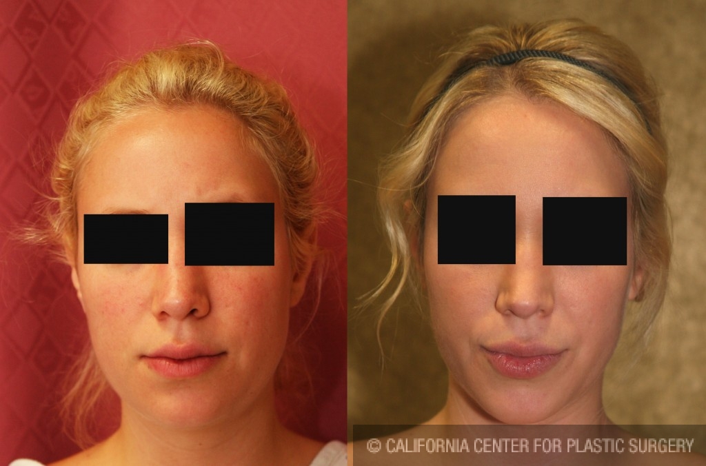 Neck & Face Liposuction Before & After Patient #6673