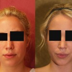 Neck & Face Liposuction Before & After Patient #6673