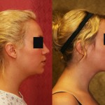 Neck & Face Liposuction Before & After Patient #6673