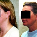 Neck & Face Liposuction Before & After Patient #6619