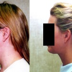 Neck & Face Liposuction Before & After Patient #6619