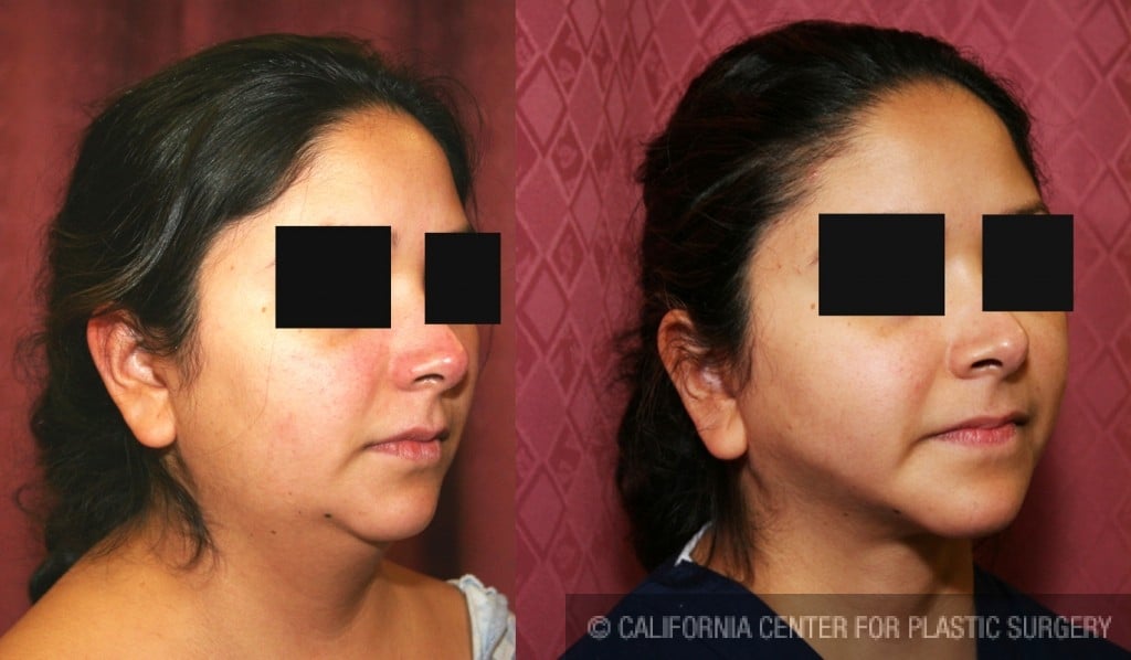 Neck & Face Liposuction Before & After Patient #6627