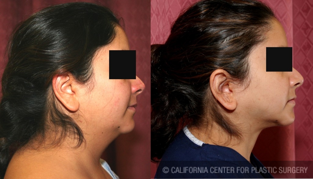 Neck & Face Liposuction Before & After Patient #6627