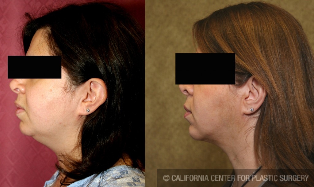 Neck & Face Liposuction Before & After Patient #6634