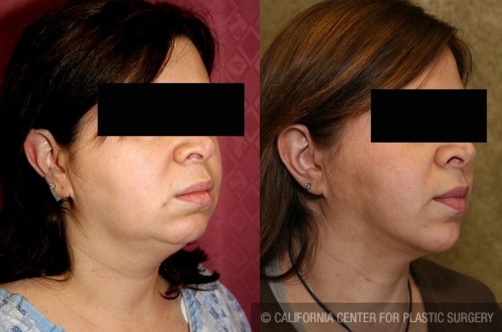 Neck & Face Liposuction Before & After Patient #6634