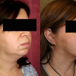 Neck & Face Liposuction Before & After Patient #6634