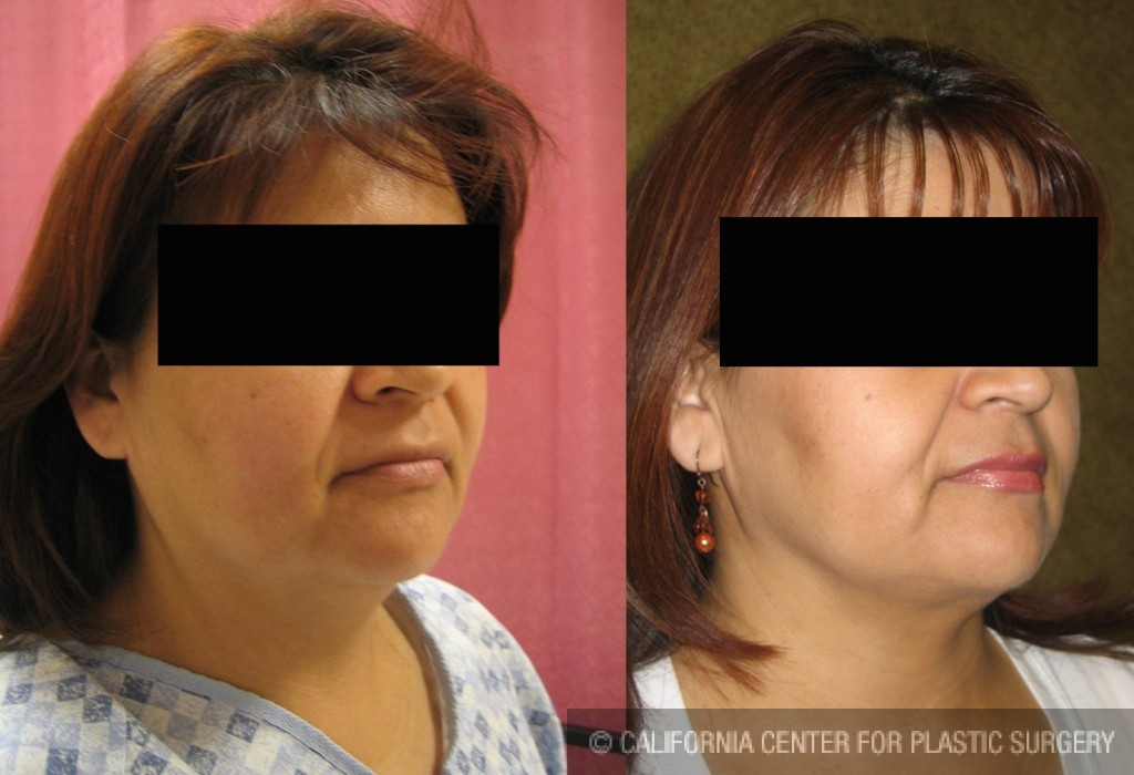 Neck & Face Liposuction Before & After Patient #6640