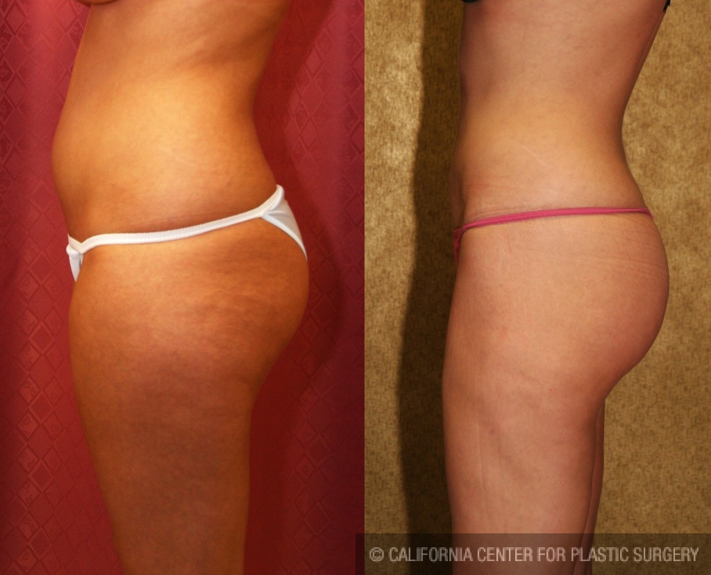 Liposuction Thighs Before & After Patient #6716
