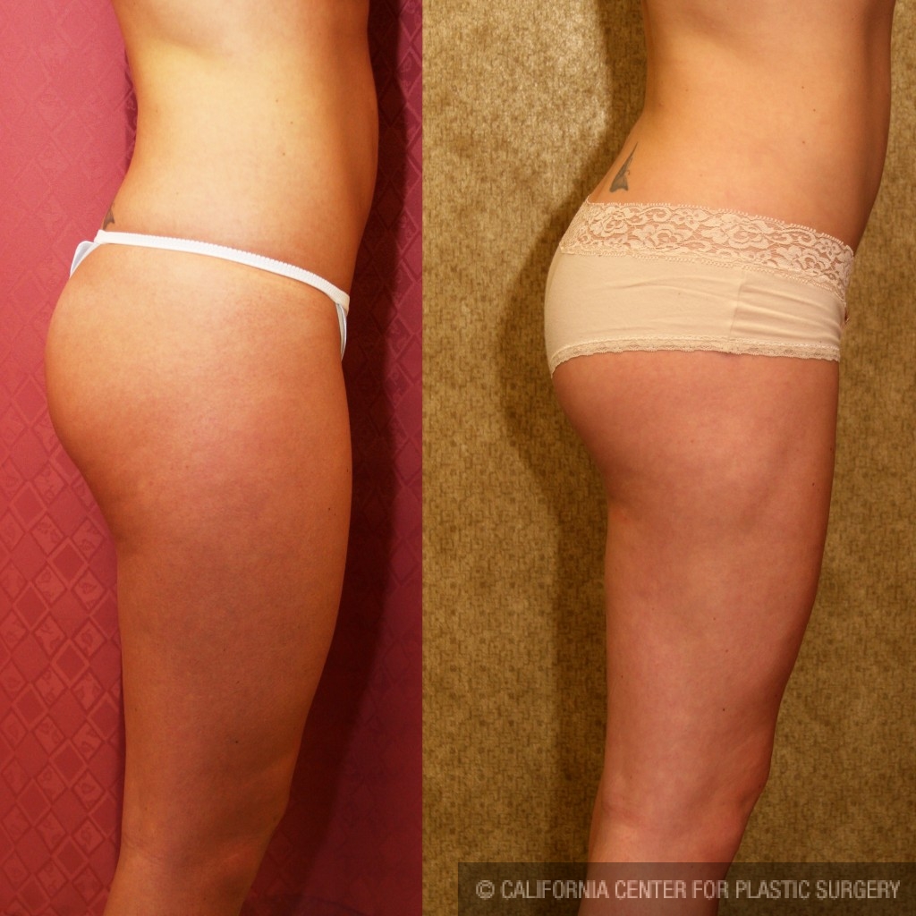 Liposuction Thighs Before & After Patient #6727