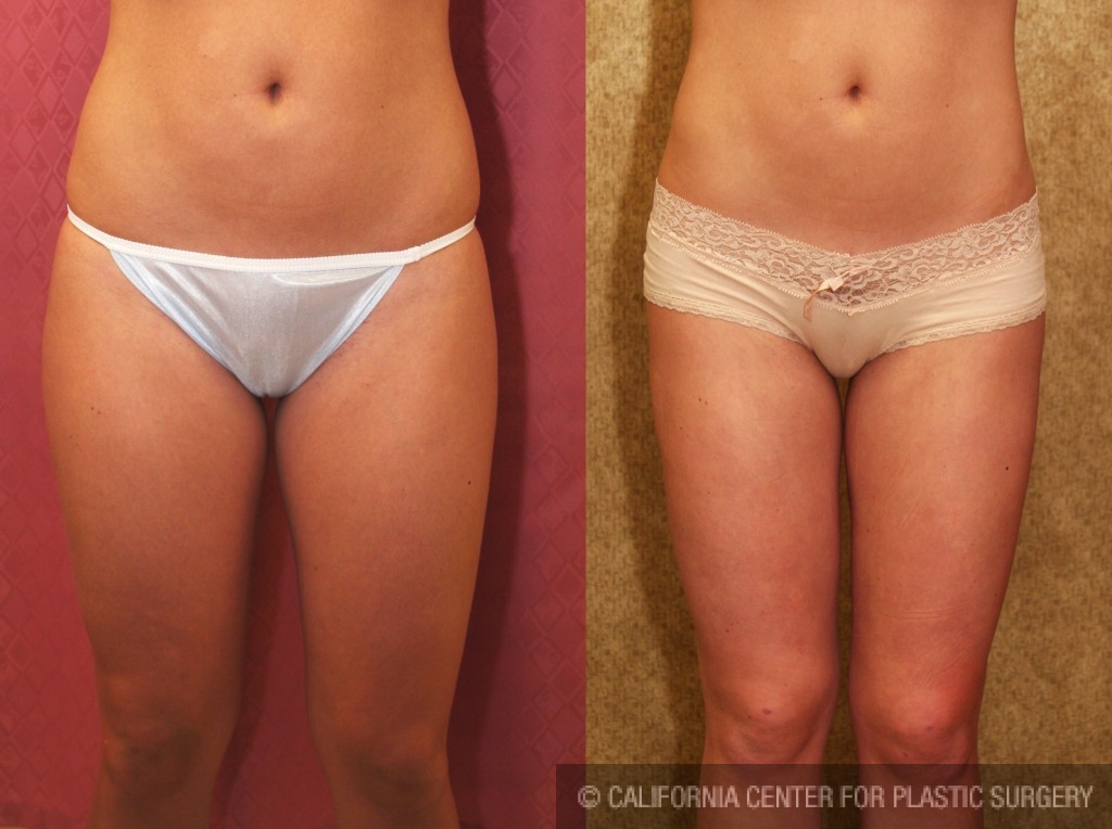 Liposuction Thighs Before & After Patient #6727