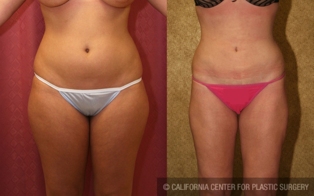 Liposuction Thighs Before & After Patient #6716