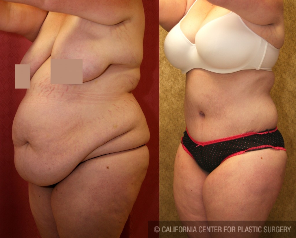 Plus Size Tummy Tuck: High BMI Tummy Tuck