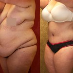 Tummy Tuck (Abdominoplasty) Plus Size Before & After Patient #5894