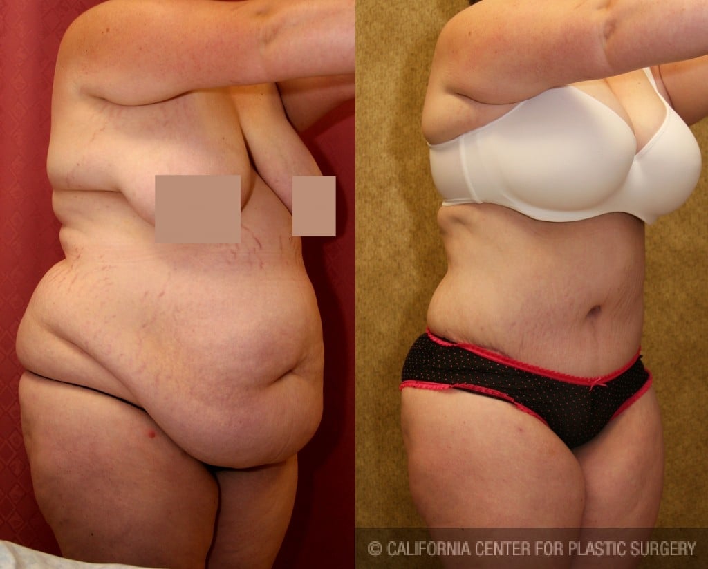 Tummy Tuck (Abdominoplasty)  Miami Plastic & Cosmetic Surgery