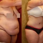 Tummy Tuck (Abdominoplasty) Plus Size Before & After Patient #5894