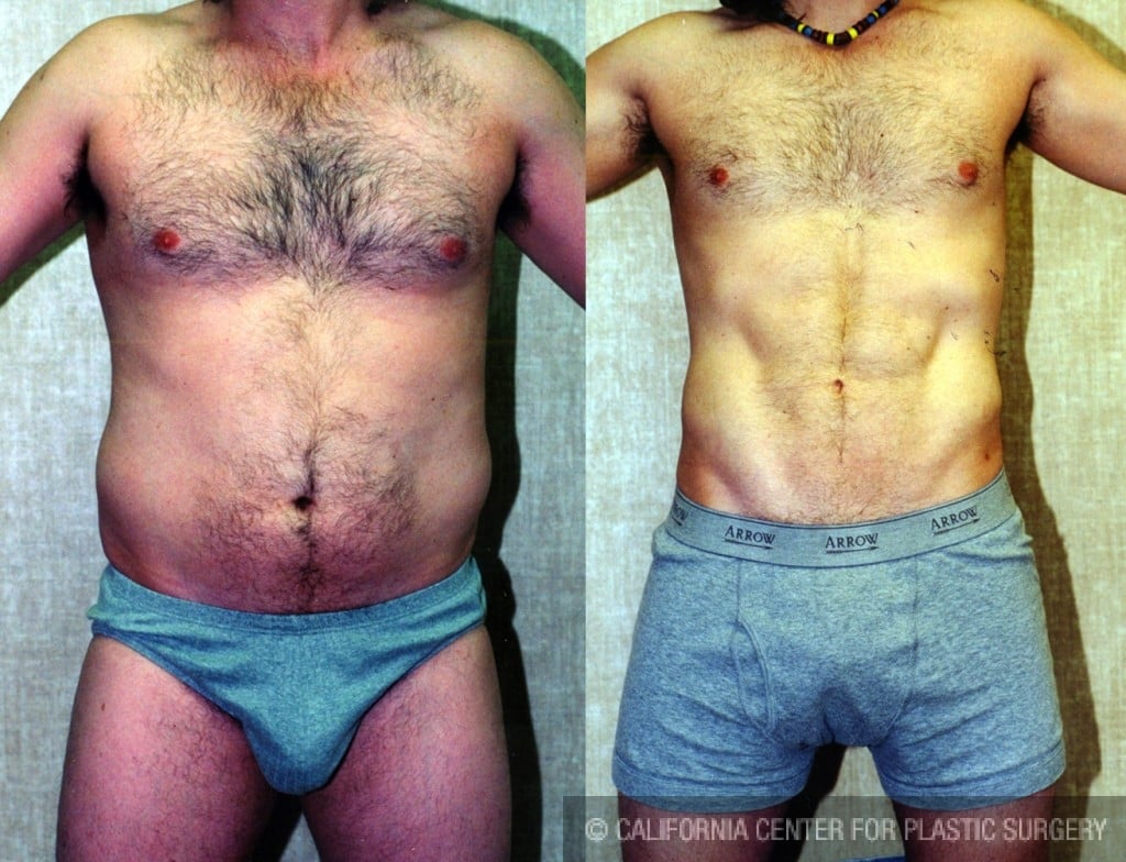 Male Liposuction Abdomen Before & After Patient #5609