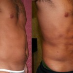 Male Liposuction Abdomen Before & After Patient #5614