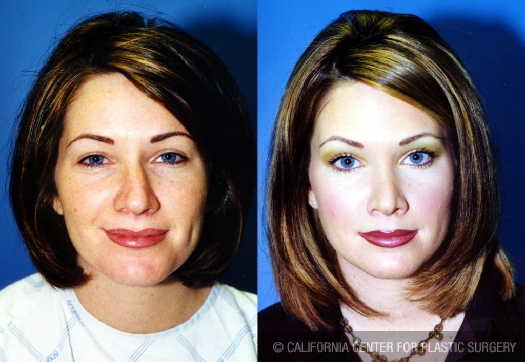 Rhinoplasty - Caucasian Before & After Patient #6184