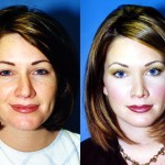 Rhinoplasty - Caucasian Before & After Patient #6184