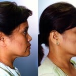 Rhinoplasty - Asian Before & After Patient #6358