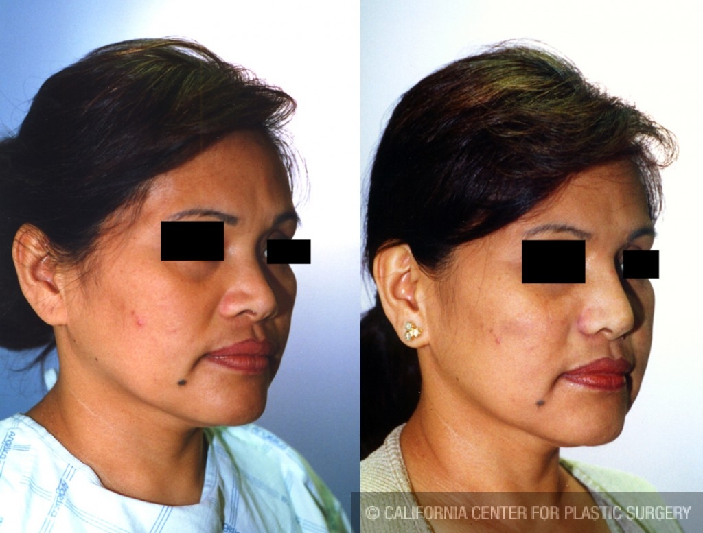 Rhinoplasty - Asian Before & After Patient #6358