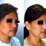 Rhinoplasty - Asian Before & After Patient #6358