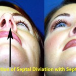 Rhinoplasty - Caucasian Before & After Patient #6184