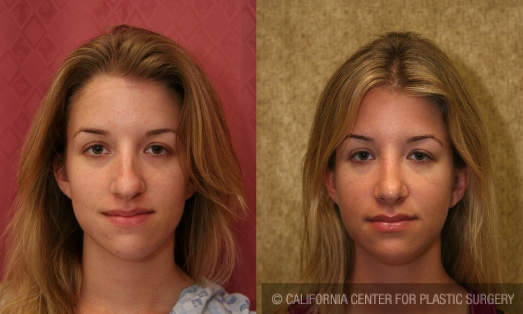 Rhinoplasty - Caucasian Before & After Patient #6190