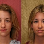 Rhinoplasty - Caucasian Before & After Patient #6190