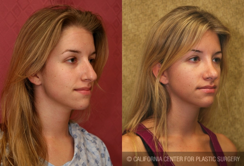 Rhinoplasty - Caucasian Before & After Patient #6190