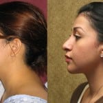 Rhinoplasty - Hispanic Before & After Patient #6272