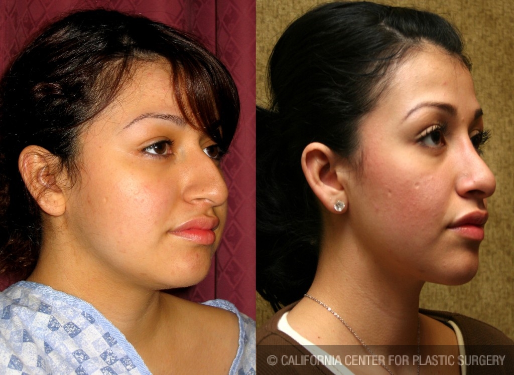 Rhinoplasty - Hispanic Before & After Patient #6272