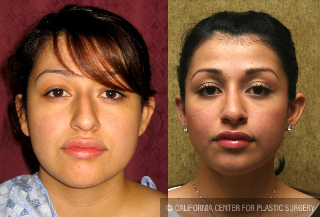 Rhinoplasty - Hispanic Before & After Patient #6272