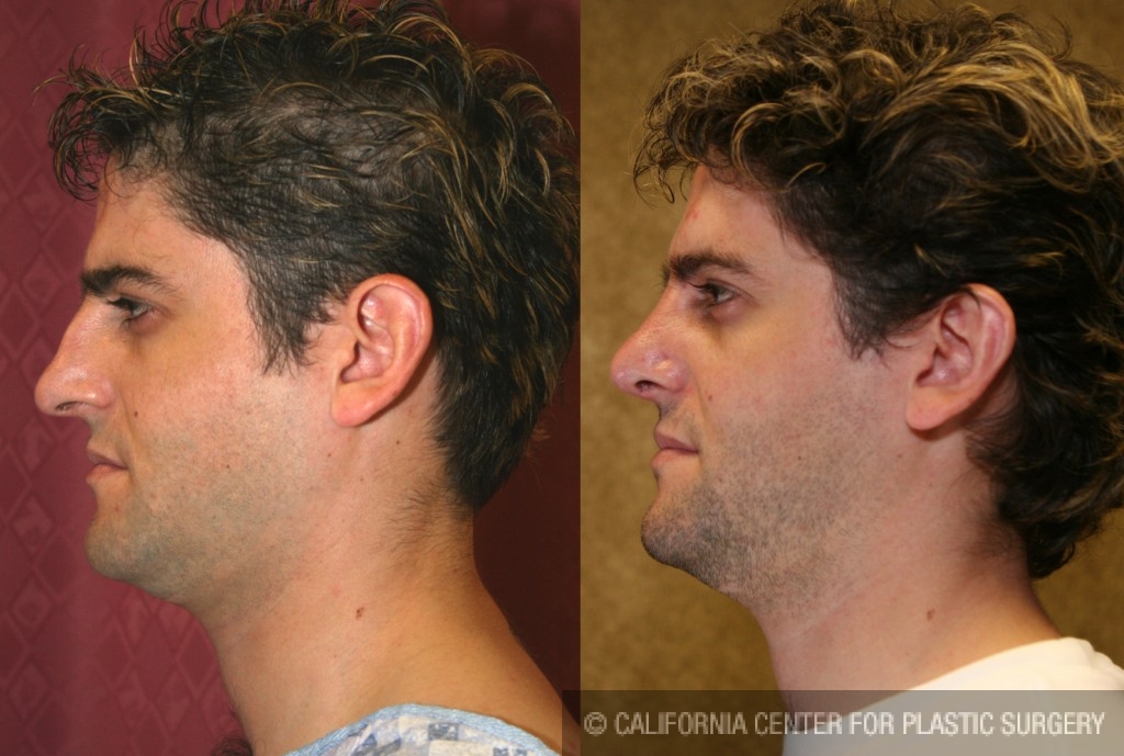 Male Rhinoplasty Before & After Patient #6424