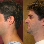 Male Rhinoplasty Before & After Patient #6424