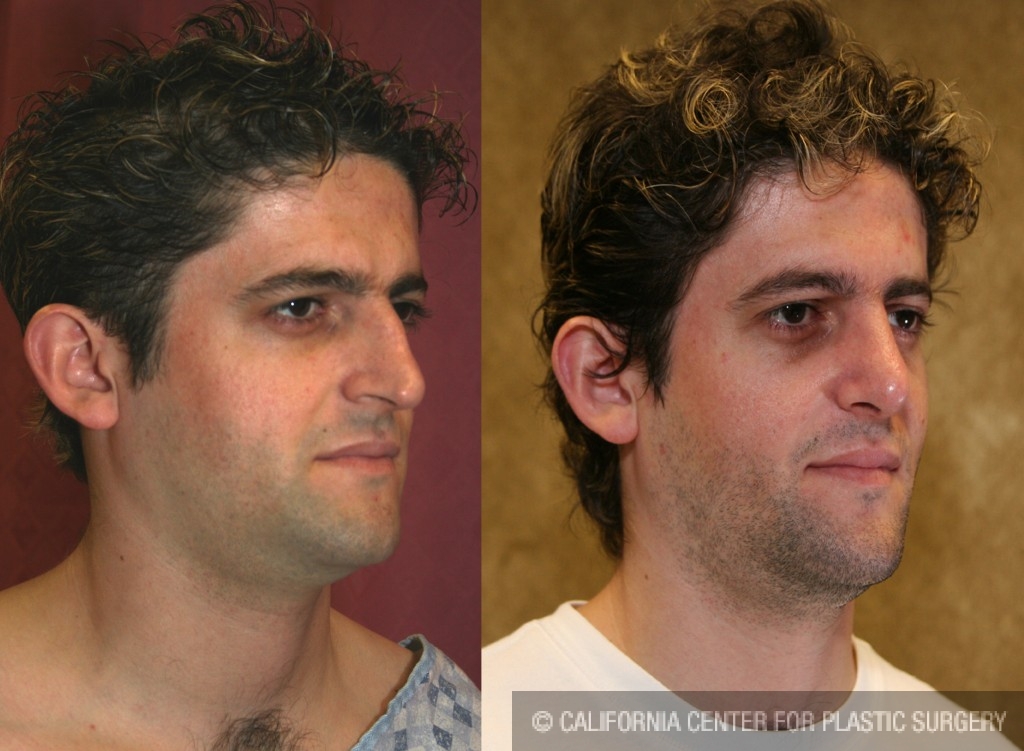 Male Rhinoplasty Before & After Patient #6424