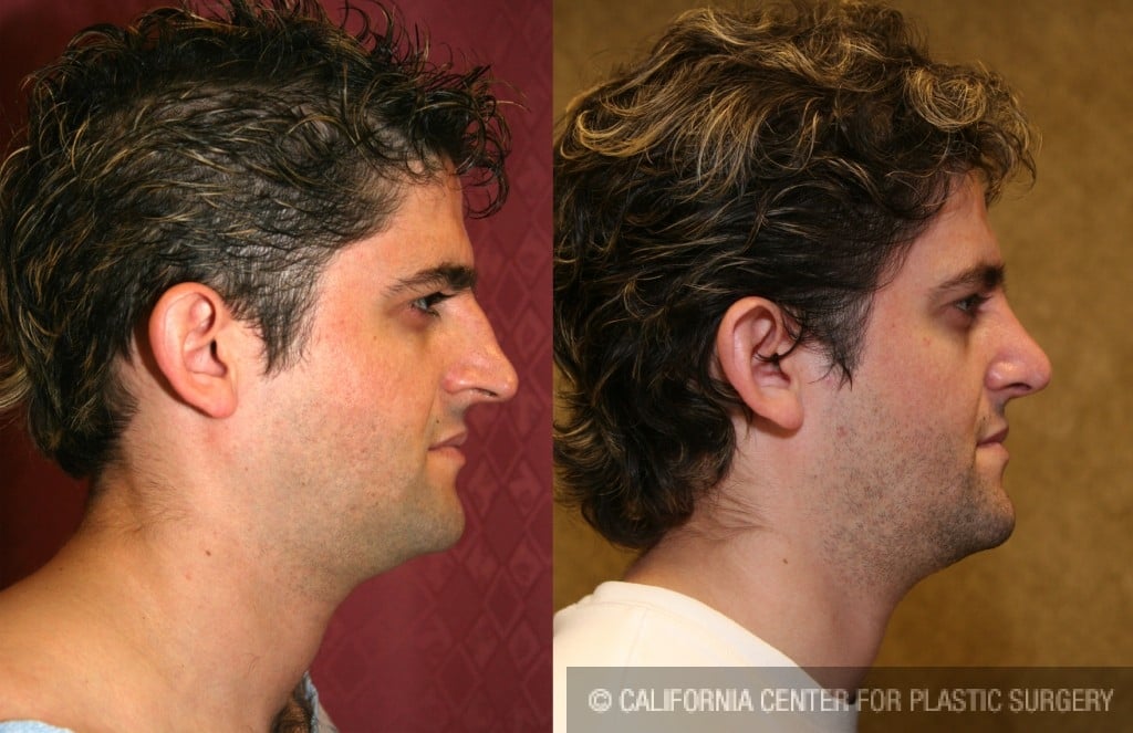 Male Rhinoplasty Before & After Patient #6424