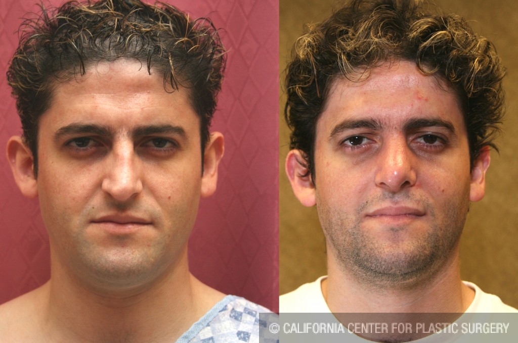 Male Rhinoplasty Before & After Patient #6424