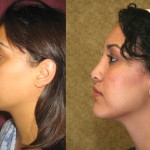 Rhinoplasty - Hispanic Before & After Patient #6264