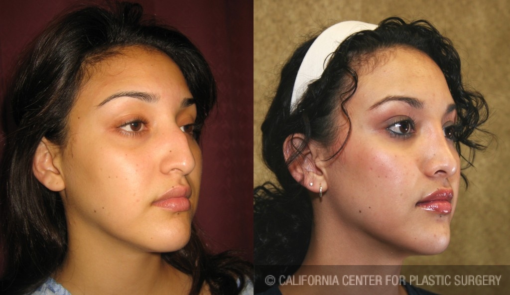 Rhinoplasty - Hispanic Before & After Patient #6264