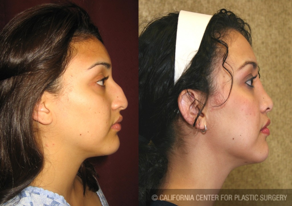 Rhinoplasty - Hispanic Before & After Patient #6264