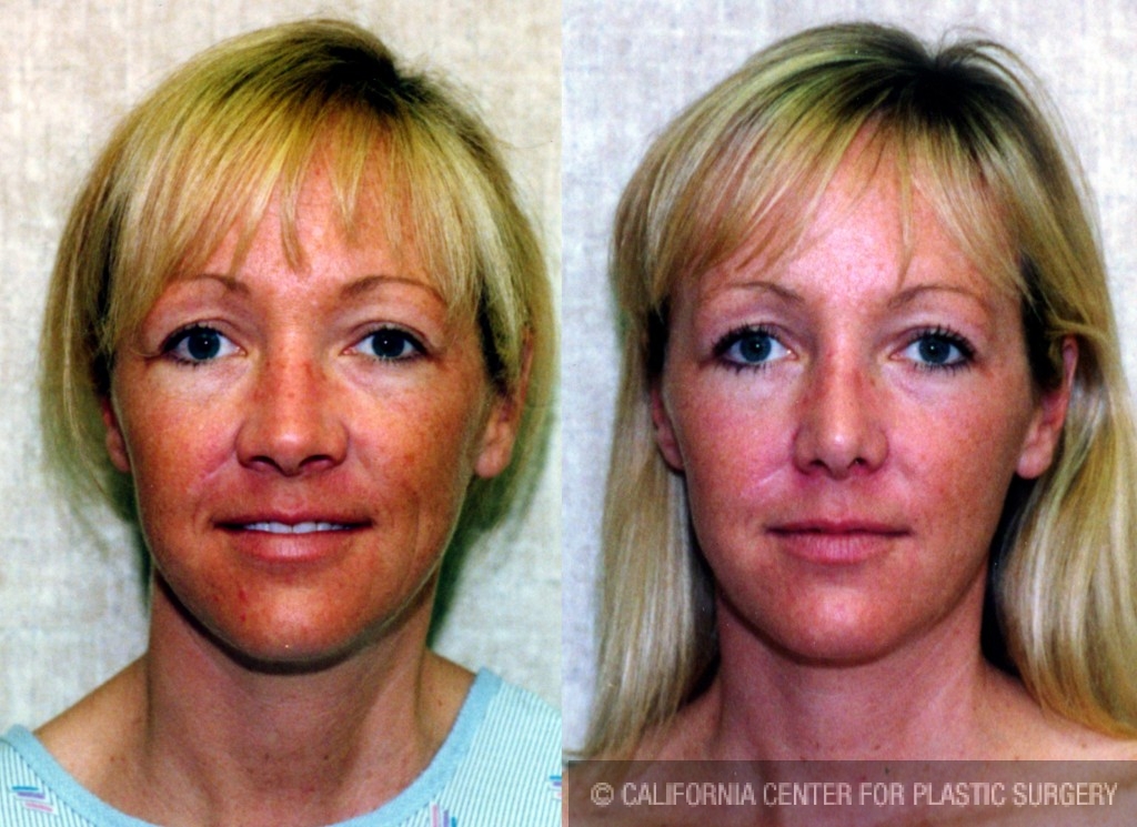 Rhinoplasty - Caucasian Before & After Patient #6247